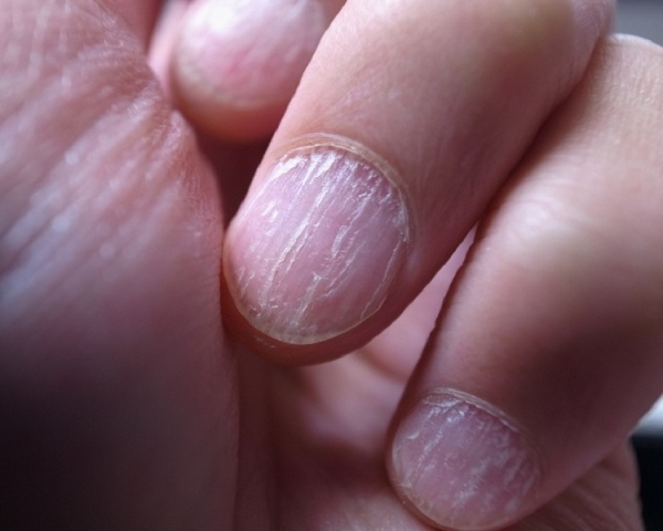 fingernail split