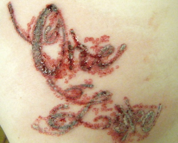Tattoo Removal Treatment - Methods Of Removing Tattoos